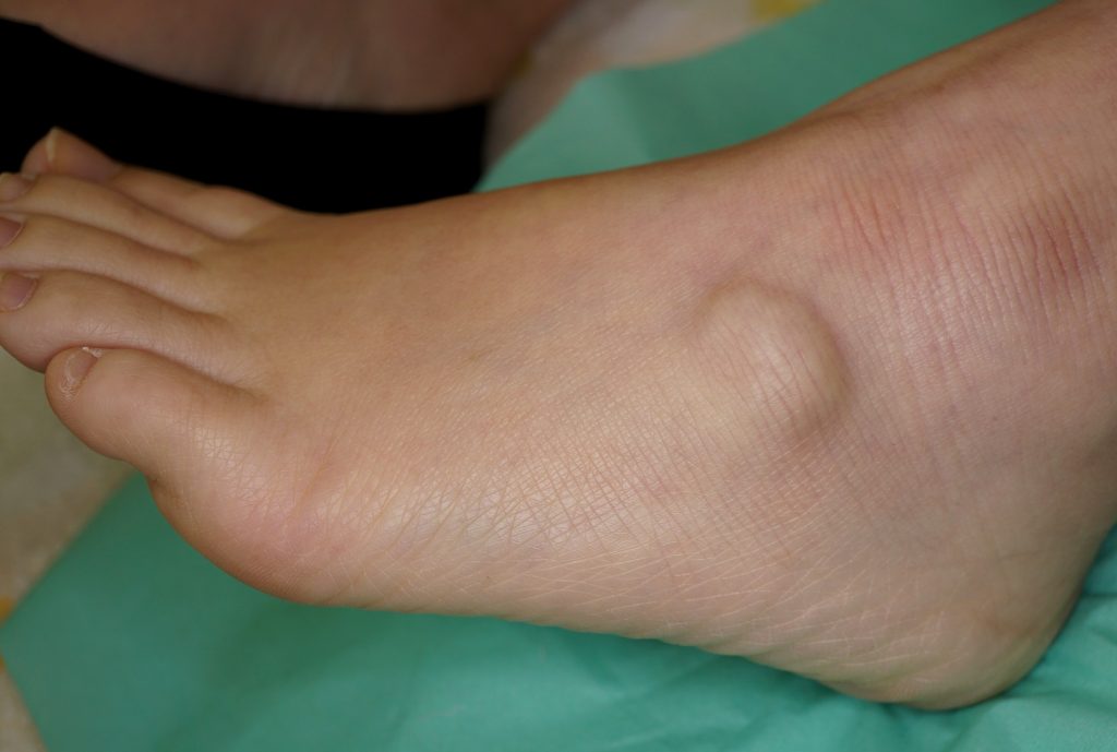 ガングリオン 足 の 甲 原因